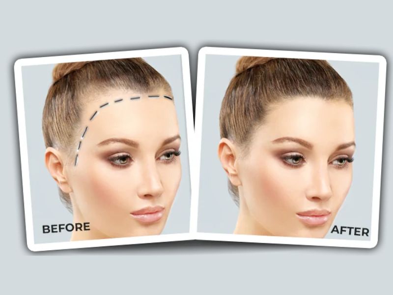 Hair Restoration for Women