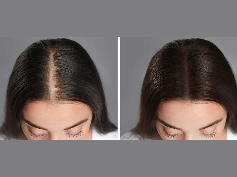 Hair Transplants For Women